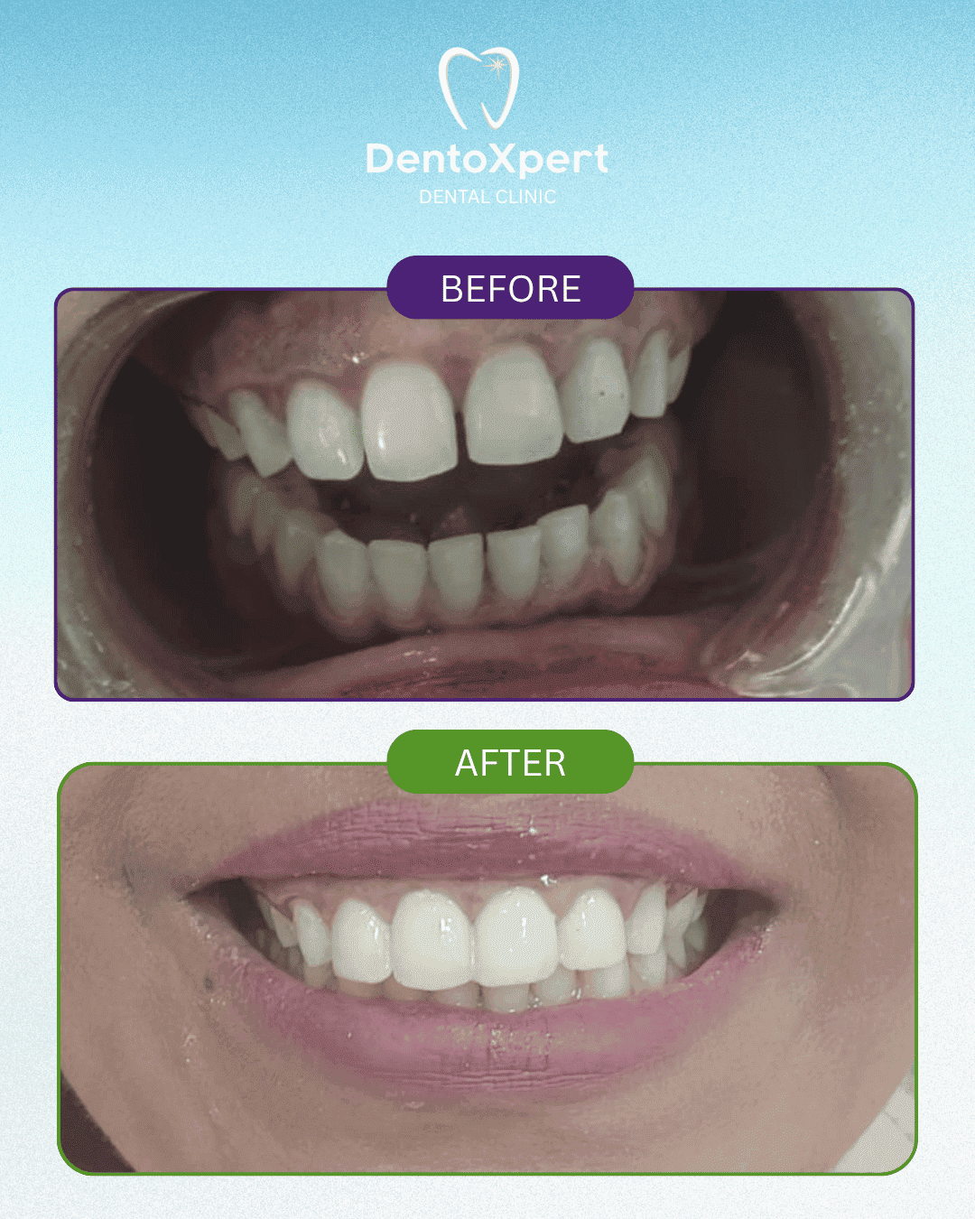 Before and after dental treatment result at DentoXpert Dental Clinic in Thane